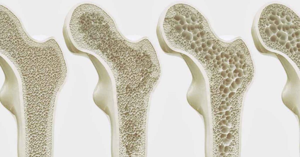 O Que é Osteoporose? Um Guia Básico para Idosos